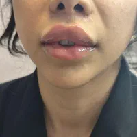 جشنواره اگزوزوم، فیلر بادی نخ،ژل،پی ارپی|خدمات آرایشگری و زیبایی|تهران, سعادت‌آباد|دیوار