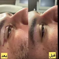 جشنواره بهاره  تزریق چربی جراحی پلک بلفارو بینی|خدمات آرایشگری و زیبایی|تهران, صادقیه|دیوار