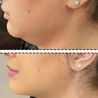 تخفیفات مدل ژل بوتاکس مزو،پاکسازی و جوانسازی صورت|خدمات آرایشگری و زیبایی|مشهد, طلاب|دیوار