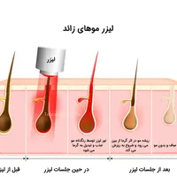 لیزر موهای زائد|خدمات آرایشگری و زیبایی|چالوس, |دیوار
