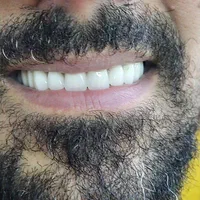 دندان مصنوعی(اقساطی)دندانسازی|خدمات آرایشگری و زیبایی|ارومیه, |دیوار