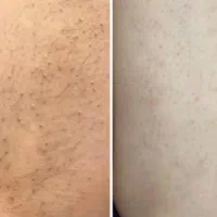 رفع تیرگی بدن در مطب پزشکی با دستگاه|خدمات آرایشگری و زیبایی|شیراز, قدوسی غربی|دیوار