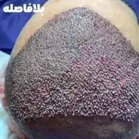 کاشت موی طبیعی|خدمات آرایشگری و زیبایی|اهواز, زیتون کارمندی|دیوار