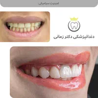 کامپوزیت و لمینت دیجیتال دندان با اقساط بلندمدت|خدمات آرایشگری و زیبایی|تهران, امیریه|دیوار