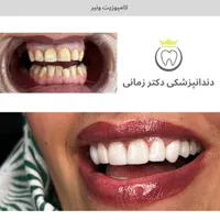 تخفیف ویژه جرمگیری و بلیچینگ (سفید کردن دندان)|خدمات آرایشگری و زیبایی|تهران, امیریه|دیوار