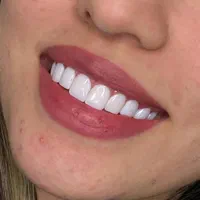 کامپوزیت دندان جشنواره تابستانه فقط تا ده روز|خدمات آرایشگری و زیبایی|کرج, گوهردشت|دیوار