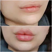 تزریق تخصصی ژل و بوتاکس با متد جدید|خدمات آرایشگری و زیبایی|تهران, نارمک|دیوار
