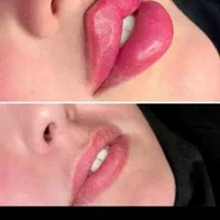 تخفیف لیزرمو،تزریق ژل لب بوتاکس هایفو لیفت صورت نخ