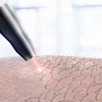 دستگاه کندلا لیزر مو غیر تماسی ارجینال