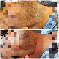 الکترولیز موهای سفیدمشکی خانم وآقا(متفاوت با لیزر)|خدمات آرایشگری و زیبایی|بندر ماهشهر, |دیوار