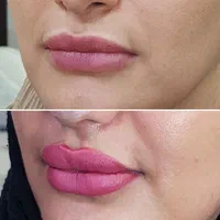 بوتاکس ژل فیلر مزوتراپی لیزر هایفو لیفت نخ در مطب|خدمات آرایشگری و زیبایی|اصفهان, مسجد مصلی|دیوار