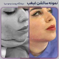 رفع و ساکشن غبغب 100% تضمین کتبی|خدمات آرایشگری و زیبایی|تهران, صادقیه|دیوار