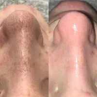 فیشال و پاکسازی پوست|خدمات آرایشگری و زیبایی|اصفهان, خواجو|دیوار