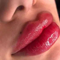 فیلر و بوتاکس با متد جدید|خدمات آرایشگری و زیبایی|رشت, گلسار|دیوار