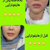 هایفو صورت،واژن.لیفت ابرو.لاغری ژل آنزیم مزو|خدمات آرایشگری و زیبایی|مشهد, آزادشهر|دیوار