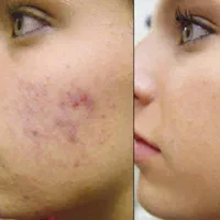 خدمات پاکسازی پوست،میکرونیدیلینگ، پلکسرواسیدتراپی|خدمات آرایشگری و زیبایی|کرج, گوهردشت|دیوار