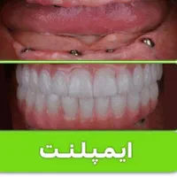 مرکز تخصصی ایمپلنت، مطب دندانپزشکی باقیمتی کم نظیر|خدمات آرایشگری و زیبایی|شیراز, قصرالدشت|دیوار