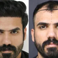 کاشت مو ب روش شیرازی درمشهد|خدمات آرایشگری و زیبایی|مشهد, احمدآباد|دیوار