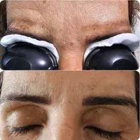 ریمو تتو و لک صورت با لیزر بدون زخم و نقاهت|خدمات آرایشگری و زیبایی|کرج, فاز ۲ مهرشهر|دیوار