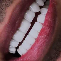 کامپوزیت دندان ، اصلاح طرح لبخند|خدمات آرایشگری و زیبایی|اصفهان, خواجو|دیوار