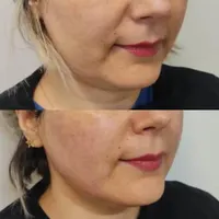 جشنواره هایفو جوانسازی لیفت پوست صورت|خدمات آرایشگری و زیبایی|تهران, صادقیه|دیوار