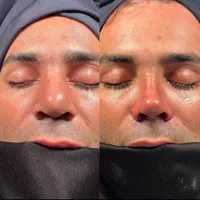 بلفاروپلاستی ،سانترال لب،لیفت ابرو،چربی صورت|خدمات آرایشگری و زیبایی|تهران, هروی|دیوار