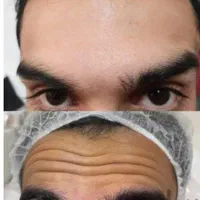 فیلر لب چانه گونه زاویه بوتاکس هایفو ژل مزو لیزر|خدمات آرایشگری و زیبایی|مشهد, فرهنگ|دیوار