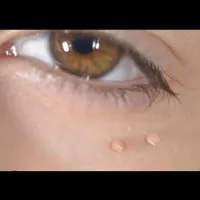 زگیل تناسلیhpv/میخچه/زیگیل/خال/بواسیر هموروئید|خدمات آرایشگری و زیبایی|تهران, دانشگاه علم و صنعت|دیوار