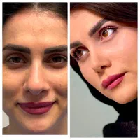 جراحی زیبائی بینی عمل بینی لیفت شقیقه پلک گوش غبغب|خدمات آرایشگری و زیبایی|اصفهان, مرداویج|دیوار
