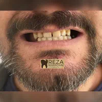 دندان مصنوعی دندانسازی پروتز متحرک|خدمات آرایشگری و زیبایی|مشهد, گلبرگ|دیوار