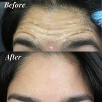 بوتاکس صورت میگرن ضدتعریق توسط پزشک کلینیک|خدمات آرایشگری و زیبایی|تهران, تهرانسر شرقی|دیوار