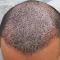 کاشت مو ۳ روزه -کاشت ابرو بدون جراحی و باجراحی|خدمات آرایشگری و زیبایی|خرم‌آباد, |دیوار