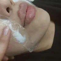 تخفیف ویژه پی ار پیprpفیلرژل بوتاکس کامپوزیت