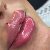 تزریق ژل لبm مادلینگmd codeلیزر بوتاکس کلینیک پوست|خدمات آرایشگری و زیبایی|تهران, ستارخان|دیوار