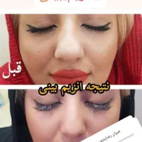 آنزیم ژل لب.بینی.غعبغب. ژل های گلوله شده چربی سوز|خدمات آرایشگری و زیبایی|خرم‌آباد, |دیوار