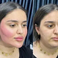 ساکشن شکم و‌پهلو بلفارو و جراحی|خدمات آرایشگری و زیبایی|مشهد, هفت تیر (حافظ)|دیوار