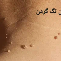 برداشتن خال زگیل میخچه باقیمت فوق العاده توسط پزشک|خدمات آرایشگری و زیبایی|اسلام‌شهر, |دیوار