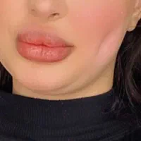 آموزش چالگونه کیلینیکی و هیدن و پیرسینگ|خدمات آرایشگری و زیبایی|مشهد, امام رضا (ع)|دیوار