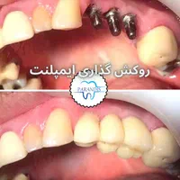 دندانپزشکی تخصصی ایمپلنت پیوند استخوان /اقساط|خدمات آرایشگری و زیبایی|تهران, پونک|دیوار