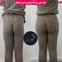 بوتاکس ژل لب زاویه فک.گونه .چانه. پرکردن صورت لاغر|خدمات آرایشگری و زیبایی|قم, زنبیل آباد|دیوار