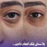 فیشال پاکسازی اسیدتراپی پلاسما خال برداری پلاژن|خدمات آرایشگری و زیبایی|قدس, شهر‌قدس|دیوار