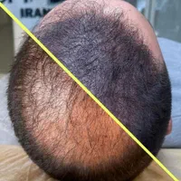 اسکالپ موی سر . بلیدینگ و میکرو پیگمنتیشن|خدمات آرایشگری و زیبایی|تهران, صادقیه|دیوار