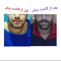 کاشت مو  ابرو  ریش به روش شیرازی|خدمات آرایشگری و زیبایی|سنندج, |دیوار
