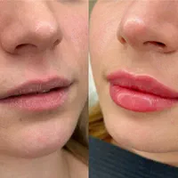 تزریق ژل و بوتاکس جشنواره|خدمات آرایشگری و زیبایی|تهران, عبدل‌آباد|دیوار