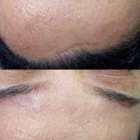 پاکسازی فیشال مزونیدلینگ اسکالپ کربوکسی پلکسر|خدمات آرایشگری و زیبایی|مشهد, رسالت|دیوار