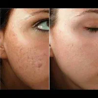 تخصصی پی آر پیprpحرفه ای بوتاکس ژل حجامت70فیلر فصد|خدمات آرایشگری و زیبایی|اصفهان, وحید|دیوار