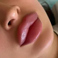 جشنواره بوتاکس،لیزر،فیلر،ژل