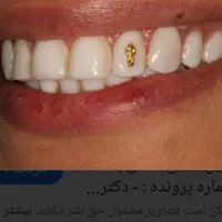 عصب کشی دندان (۱۲۰۰) دندانپزشکی تعرفه دولتی|خدمات آرایشگری و زیبایی|کرج, برغان|دیوار
