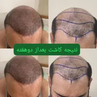 کاشت مو تراکم بالا (بدون تراشیدن سر)|خدمات آرایشگری و زیبایی|محمدشهر, |دیوار