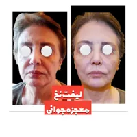 لیفت نخ معجزه جوانی و لیفتینگ صورت بدون جراحی|خدمات آرایشگری و زیبایی|شاهین‌شهر, فردوسی|دیوار